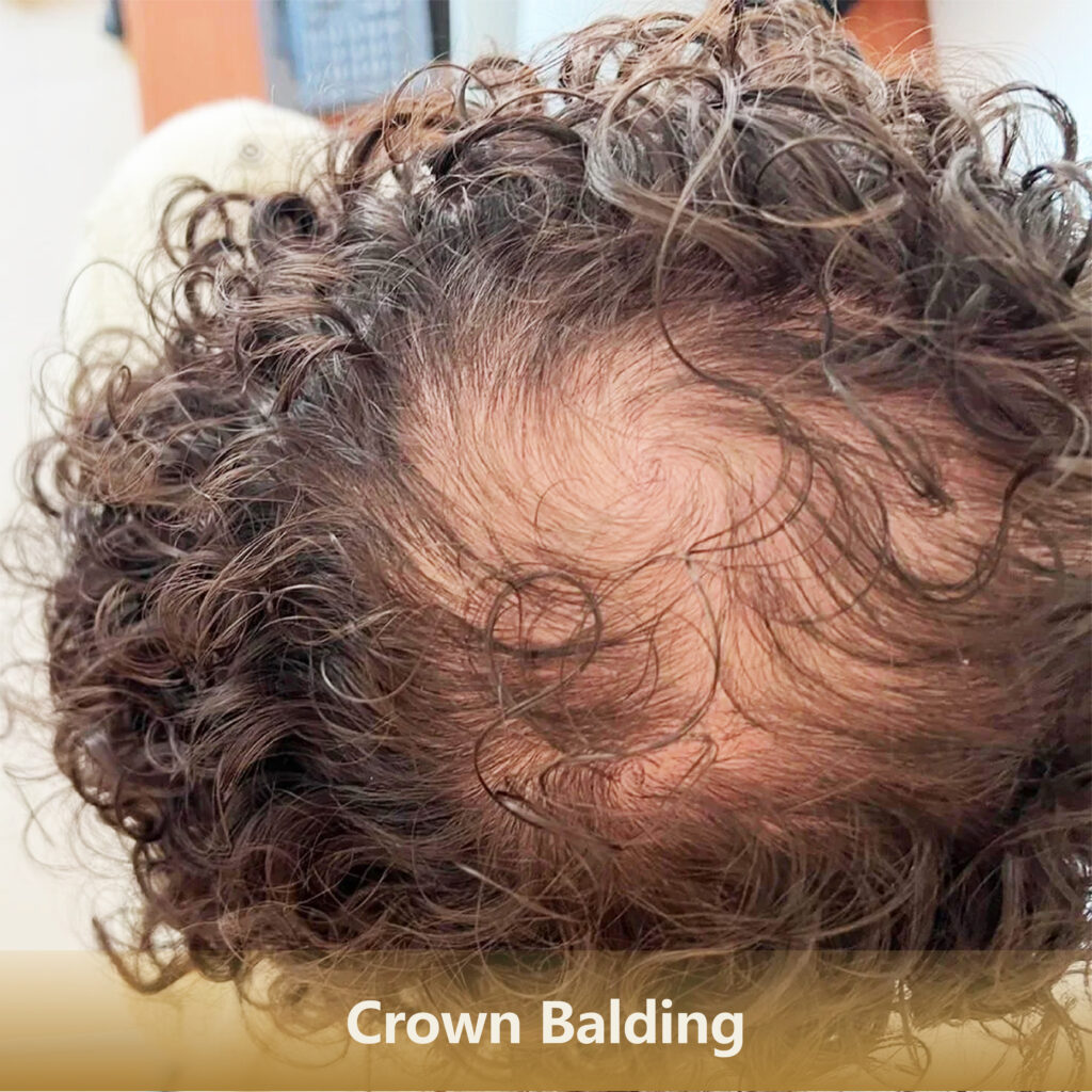 4 地中海Crown Balding 1 1024x1024